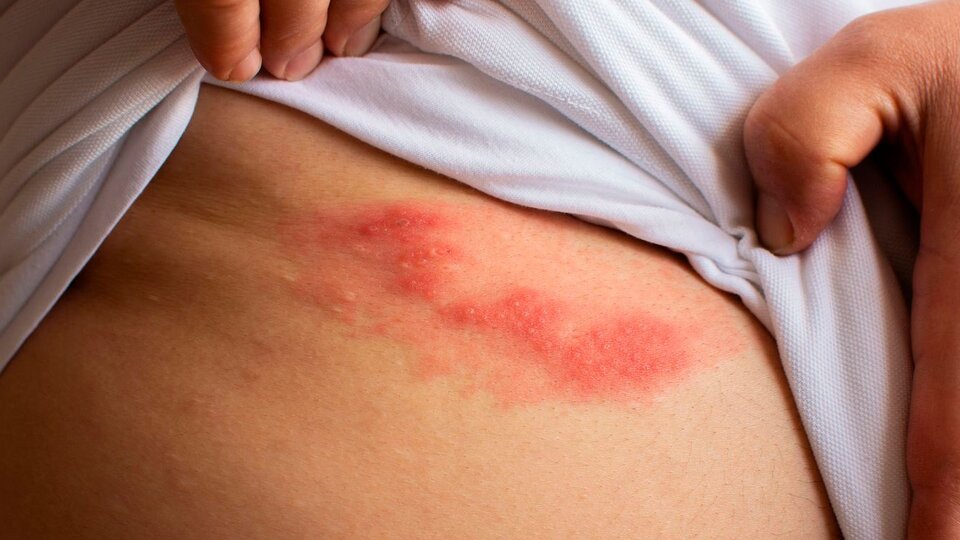 Understanding Herpes Zoster (Shingles): Causes, Symptoms, Complications and Vaccines