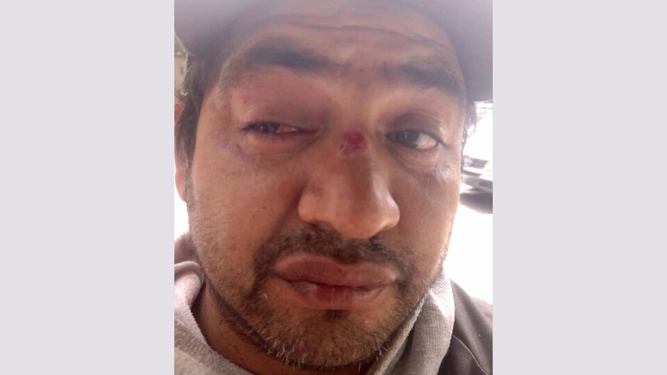 Protocolo antiprotestas: Un manifestante perdió la visión de un ojo por la represión  | Un integrante de UTEP fue herido durante la marcha por reclamo de alimentos de la semana pasada