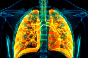 Un hallazgo abre la puerta a un tratamiento para un tipo de cáncer de pulmón agresivo