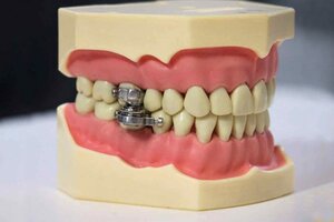 Un candado en los dientes para no abrir la boca: el nuevo dispositivo para adelgazar que desató la polémica (Fuente: Universidad de Otago)
