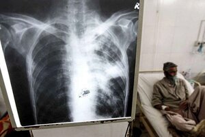 Por primera vez en diez años aumentaron las muertes por tuberculosis en el mundo (Fuente: EFE)