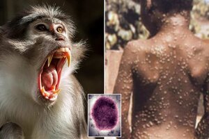 Por qué surgen más enfermedades desconocidas como la hepatitis y la viruela del mono
