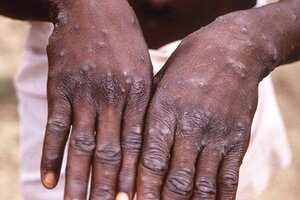Desde ONUSIDA remarcaron que la enfermedad "puede afectar a cualquiera". Foto: Centros para el Control y Prevención de Enfermedades.