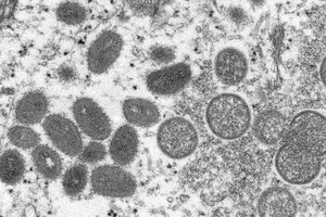 Imagen microscópica de la viruela actuando y desarrollándose en el cuerpo humano.