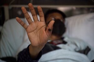 Un paciente infectado en Perú muestra las lesiones en la piel causadas por la viruela símica (Foto: AFP).