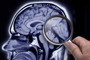 Alzheimer: un hallazgo podría permitir la detección temprana (Fuente: AFP)