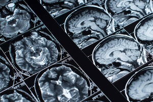 Alzheimer: especialistas avanzan en su detección temprana con Inteligencia Artificial (Fuente: Universidad de Chile)