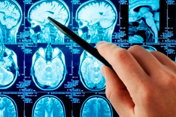 Qué es un aneurisma cerebral y cómo tratarlo