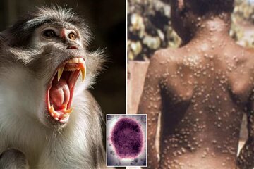 Por qué surgen más enfermedades raras como la hepatitis desconocida y la viruela del mono