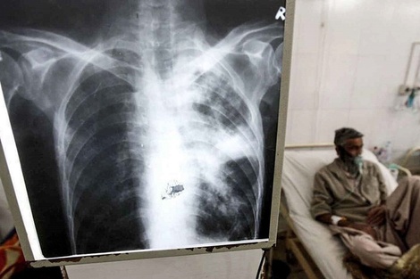 Por primera vez en diez años aumentaron las muertes por tuberculosis en el mundo