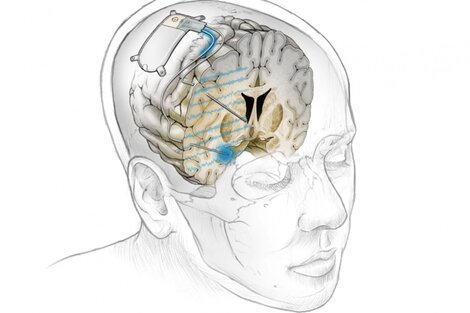 Usan un implante cerebral para eliminar los pensamientos negativos y así prevenir la depresión