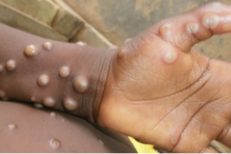Qué causa la viruela del mono - Imagen: Centros para el Control y la Prevención de Enfermedades (CDC)