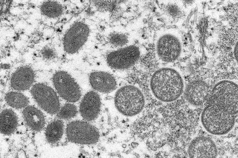 Partículas ovales de virus maduros de viruela del mono en una muestra clínica de piel humana. Foto: AFP/CDC/Archivo