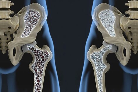 La osteoporosis causa 90 fracturas de cadera por día en Argentina: cómo prevenirla