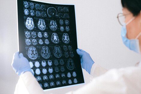 De qué se trata donanemab, el nuevo medicamento para tratar el Alzheimer