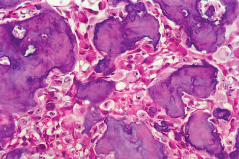 Qué es el osteoblastoma, un tumor que saltó a la fama recientemente