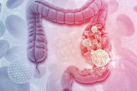 Día Mundial Contra el Cáncer de Colon: advierten que los malos hábitos alimenticios inciden en la enfermedad