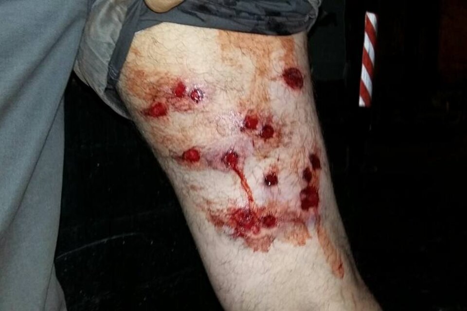 Las heridas de los vecinos que fueron reprimidos con balas de goma de la Policía de la Ciudad.  (Fuente: Twitter)
