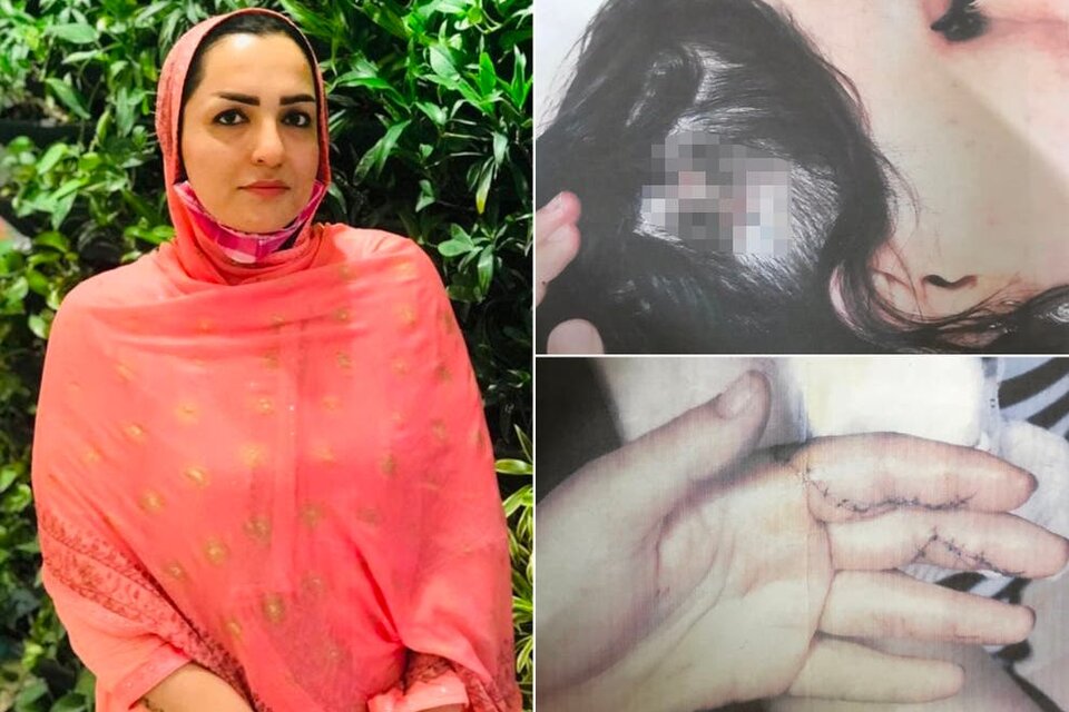 Fariba Akemi y las heridas que le infligió su esposo talibán. (Fuente: The Independent)