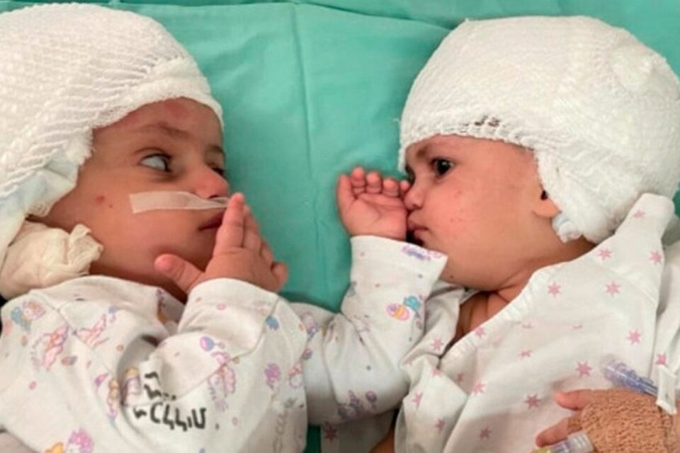 Separaron con éxito a dos gemelas de un año que estaban unidas por la cabeza