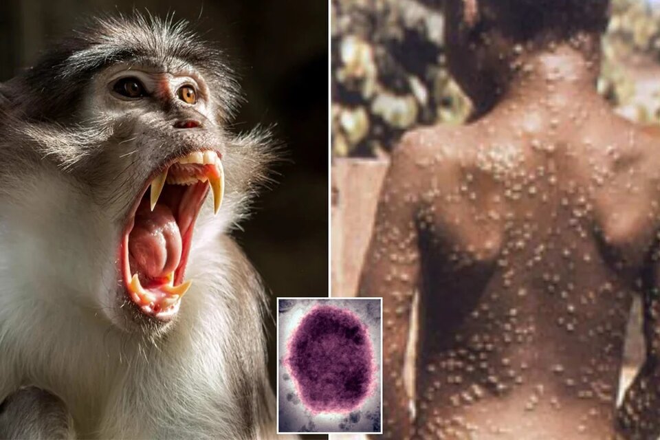 La viruela del mono ya se conocía en Africa, pero se detectaron casos en Europa.