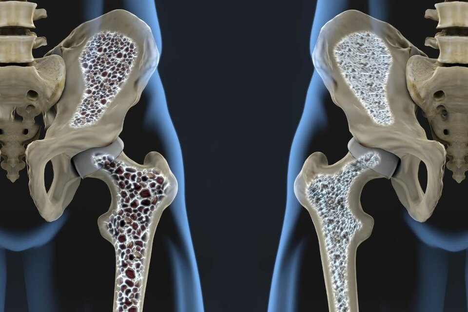 La osteoporosis causa 90 fracturas de cadera por día en Argentina: cómo prevenirla