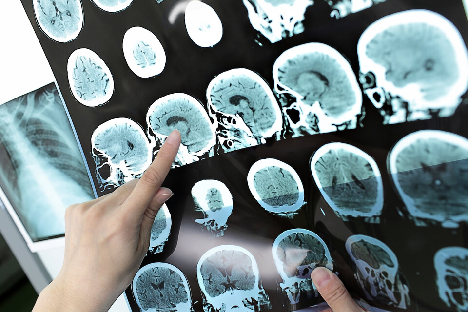Nuevas pistas para la identificación temprana de Alzheimer
