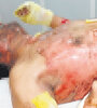 Héctor Reyes Corvalán tiene el 45 por ciento del cuerpo quemado y su vida corre peligro.