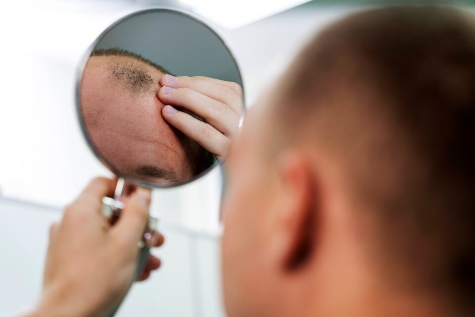 Alopecia: ¿por qué se cae el pelo y qué estrategias propone la ciencia para revertir el proceso?