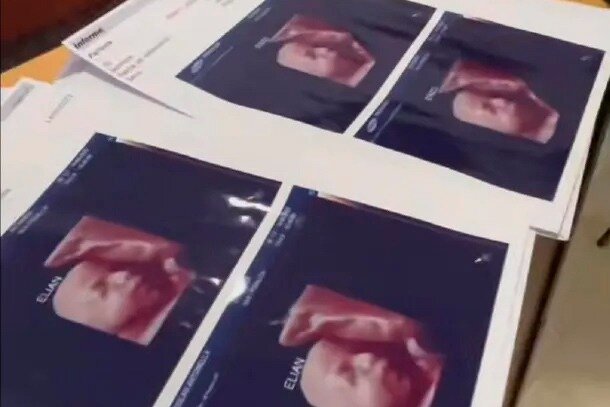 Una clínica de ecografías entregaba la misma foto a todas las embarazadas